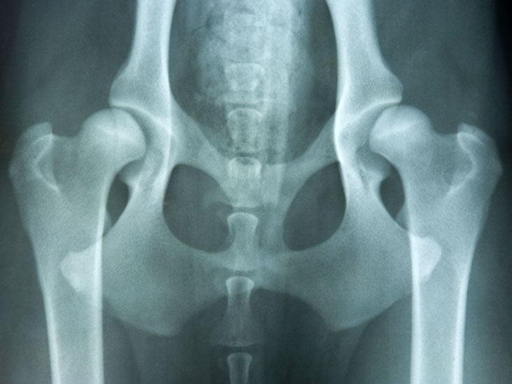 normal hip xray with pain and weakness