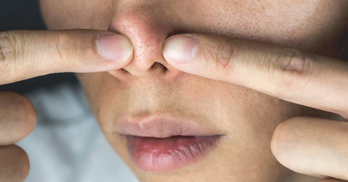 about-the-white-stuff-that-comes-out-when-you-squeeze-your-nose-pores