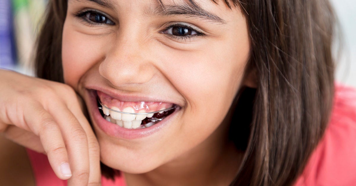 girl laughing wearing retainers 1200x628 facebook