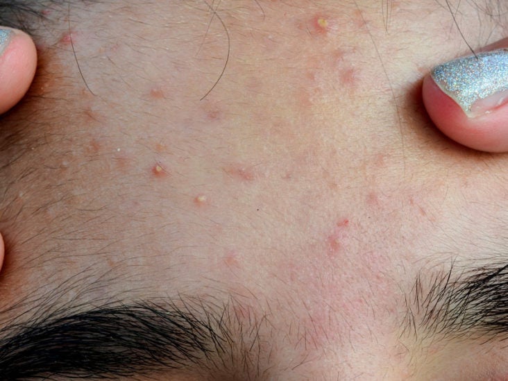 Managing Itchy Acne Symptoms Causes And Treatment