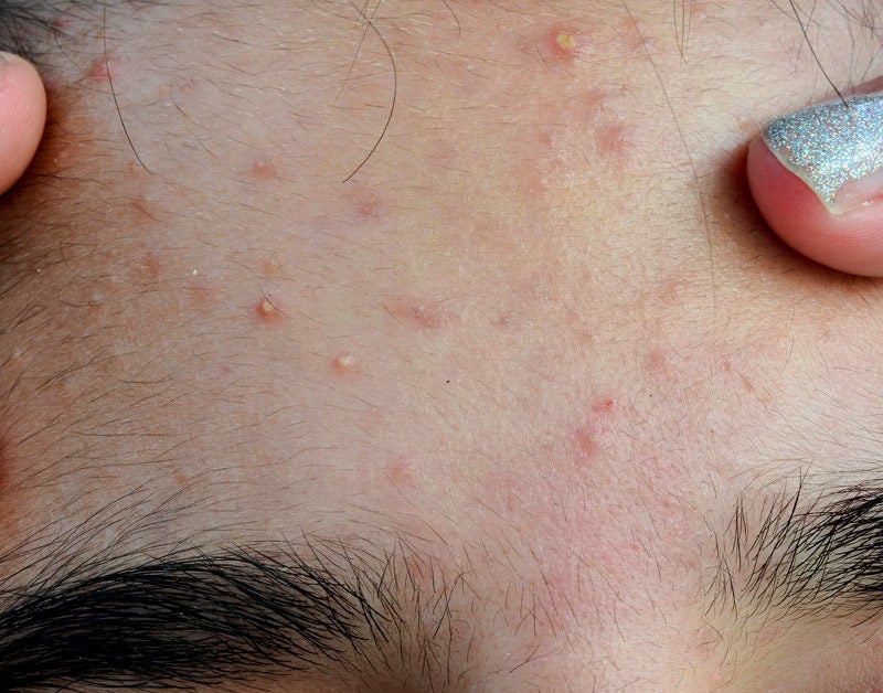 Can an allergic reaction look like acne