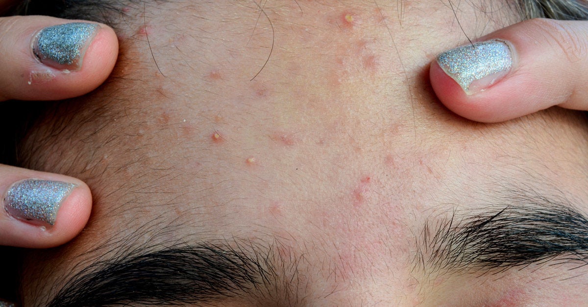 Managing Itchy Acne Symptoms Causes And Treatment