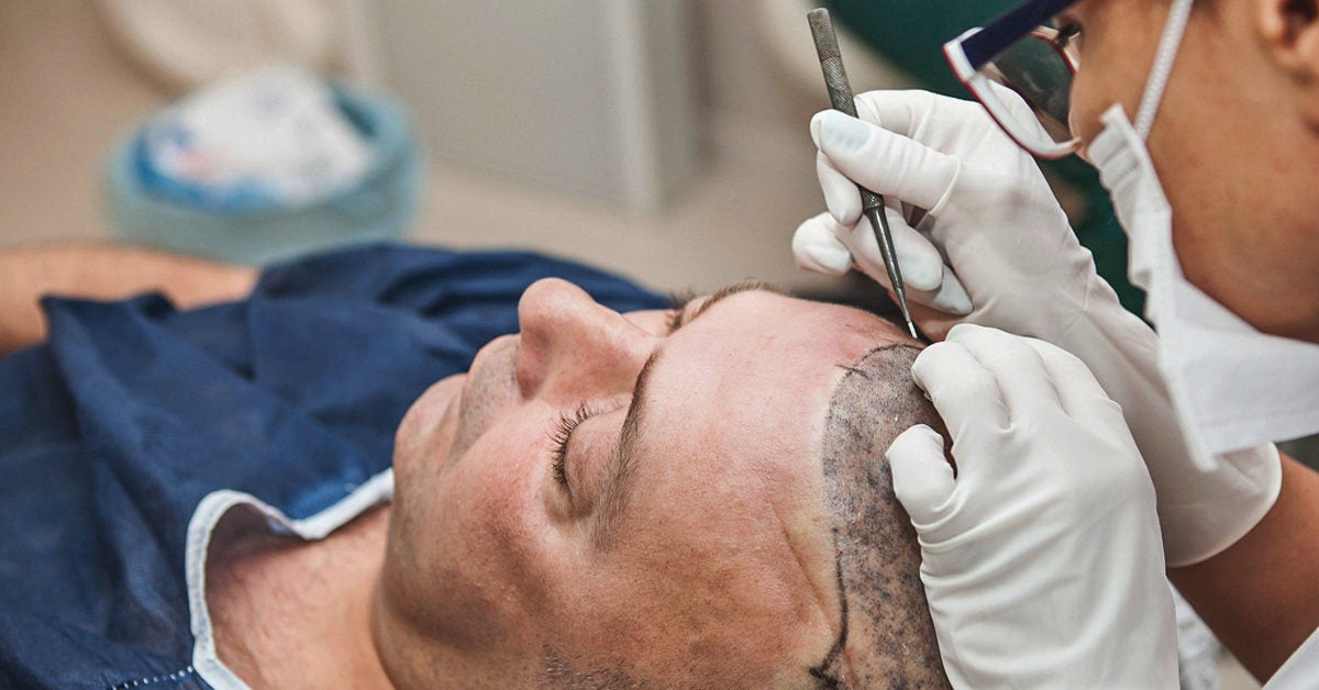 Hair Transplant Scar: Is It Permanent or Can It Be Removed?