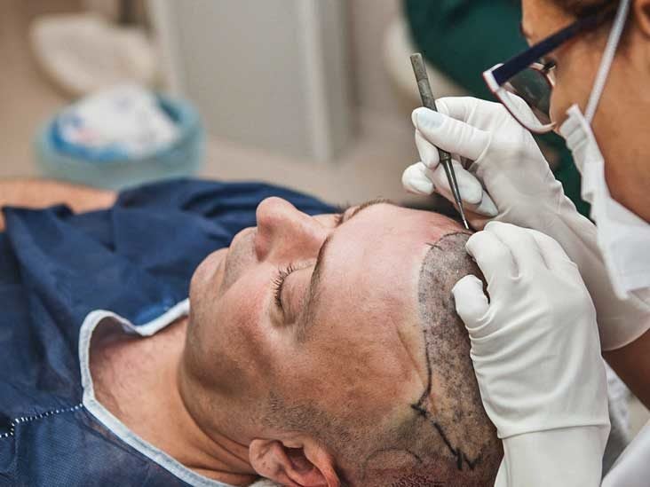 Does Hair Transplant Work? Effectiveness, Side Effects, and Photos