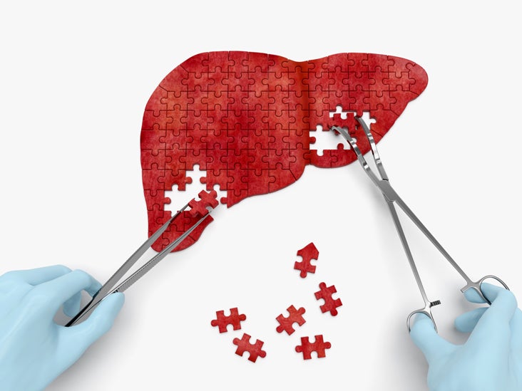 Liver Biopsy: Purpose, Procedure, and Risks