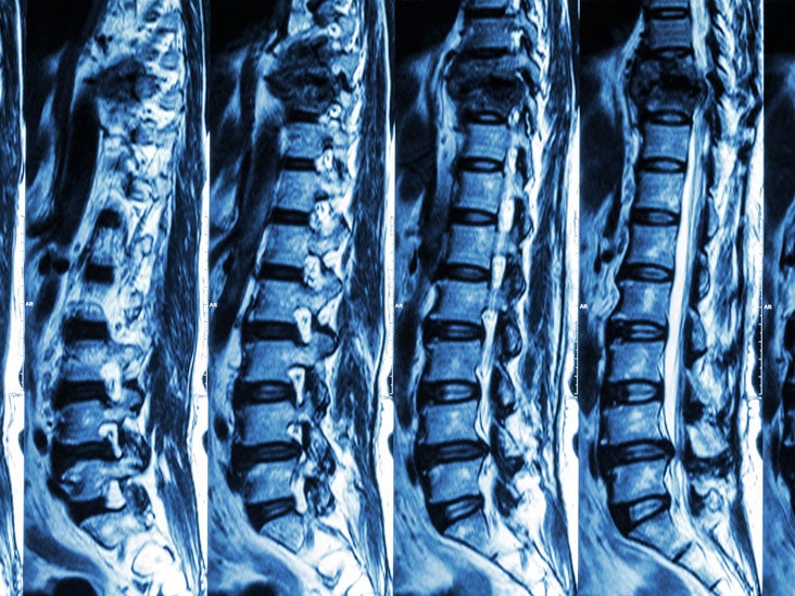 Lumbar Spine CT Scan: Purpose, Procedure & Risks