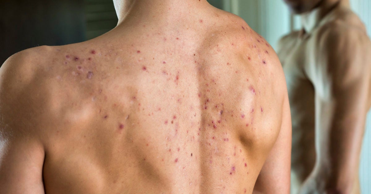 Cystic Acne On Back Causes And Treatment