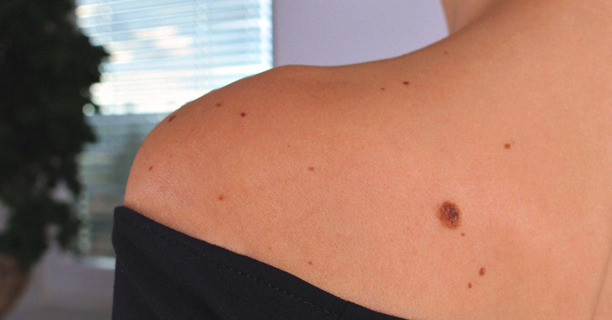 Nevus Definition, Common Types, Photos, Diagnosis, and Treatment