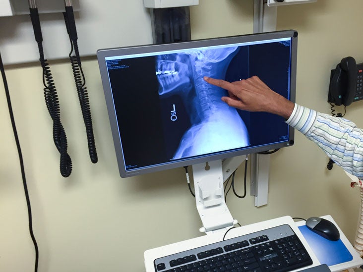 See The Amazing X Ray After Neck Ring Removal Surgery - av11rqq