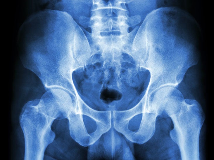 normal hip xray female human