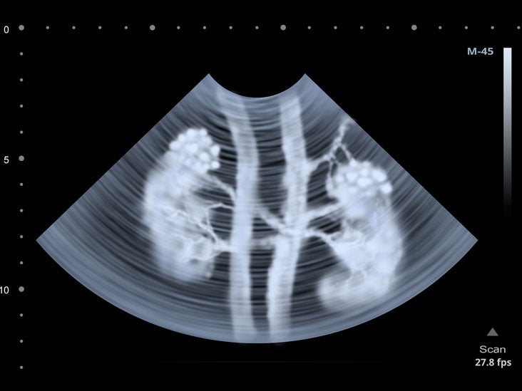 Clear Insights: Understanding Kidney Health through Ultrasound Scans