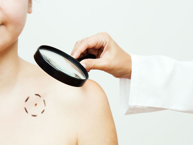 Skin Cancer Symptoms: Pictures, Types, and More