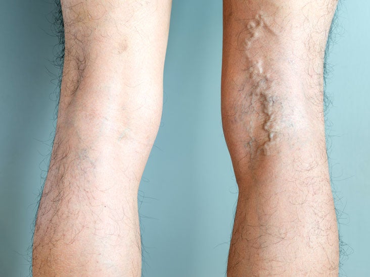 spider veins treatment in ny