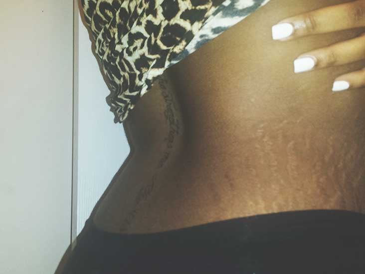 How to get rid of stretch marks