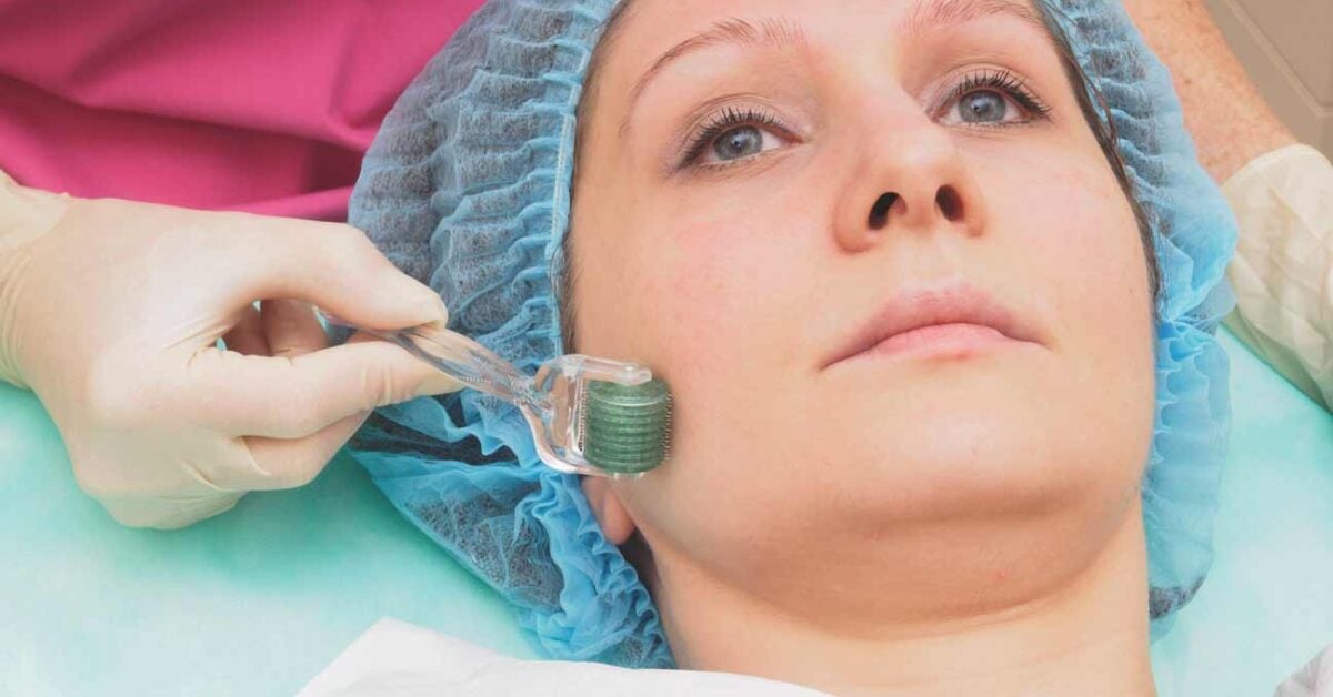 Microneedling: Is It Worth the Hype?