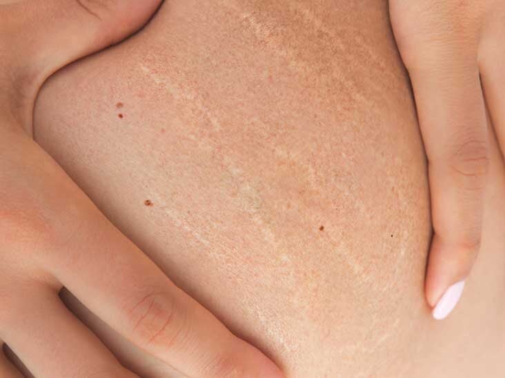 Stretch Marks: How to Get Rid of Them, Causes, and More