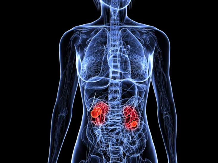 understanding-the-spread-metastatic-renal-cell-carcinoma