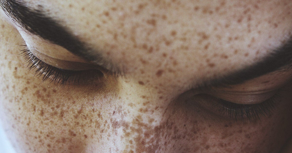 Remove freckles to naturally moles how and How to