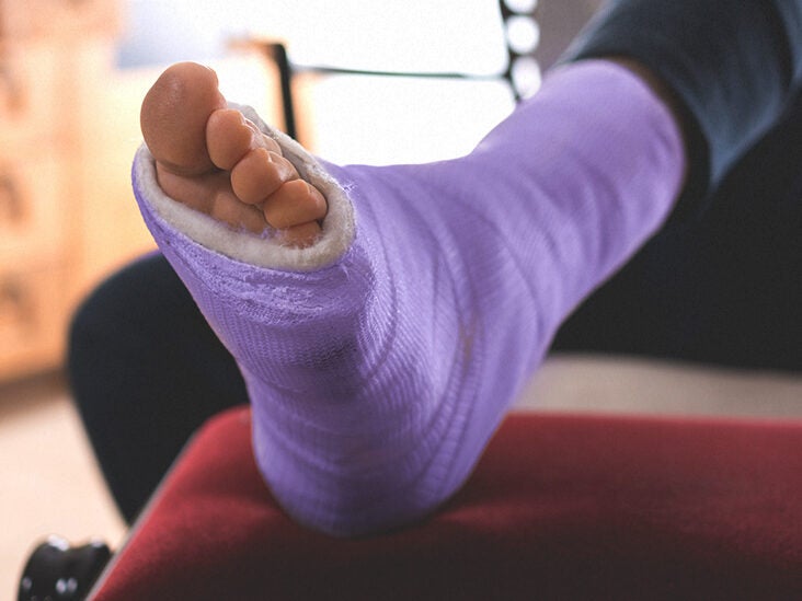 Rekwisieten Sportschool Hoge blootstelling Broken Leg: Symptoms, Treatment, and Recovery Time