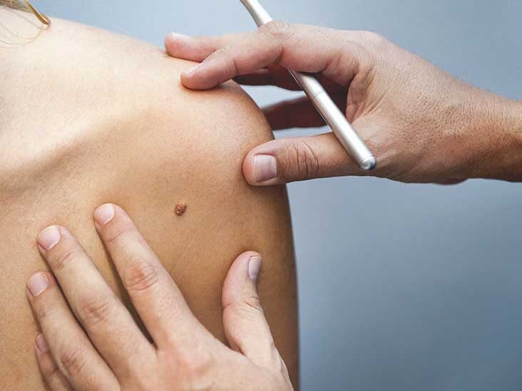 What to expect when you have a mole removed   MD Anderson Cancer Center