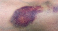 direkte Pearly Bliv Bruise: Pictures, Types, Symptoms, and Causes