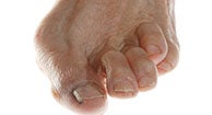 Miért fáj egy nagy lábujj? 6 ok - Big toe arthritis kenőcs