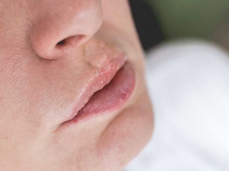 What allergic reaction causes lips to swell