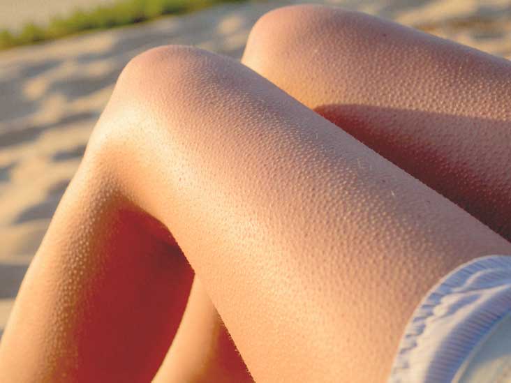 Goosebumps on Skin: When You're Not Cold and More