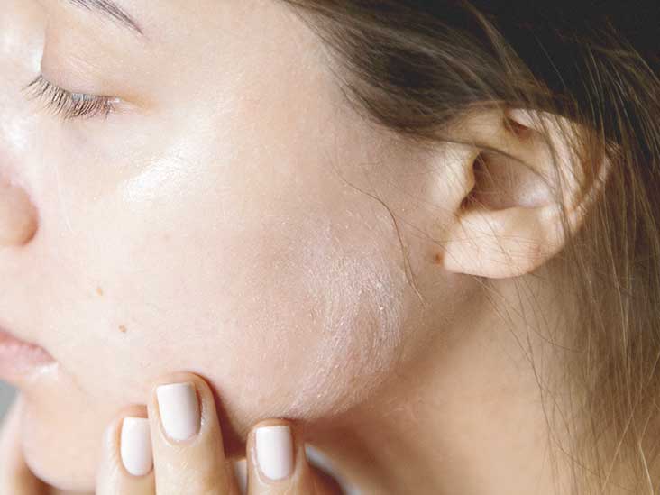 Red Skin Syndrome Stages Treatment Healing And More