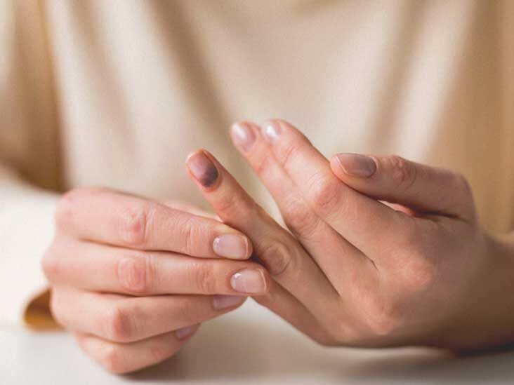 Nail Bed Injury Types Causes And Treatments