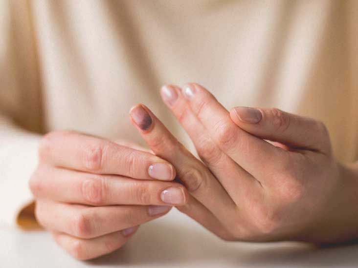 Smashed Finger: Treatment, Recovery, Seeking Help, and More