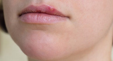 Bumps lips little on Small White