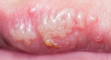 Do pearly penile papules go away