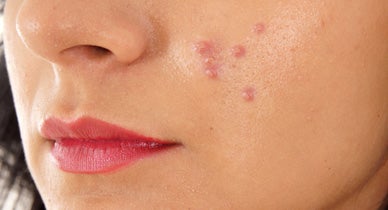 Accutane: What Are the Side Effects on the Body?