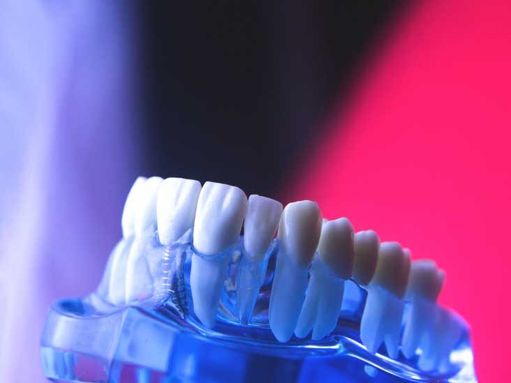Dental Crown Types, Procedure, When Itamp#39;s Done, Cost, and Aftercare