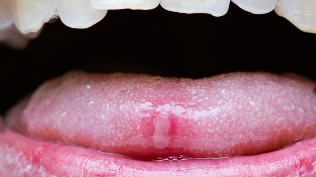 warts on tongue not painful