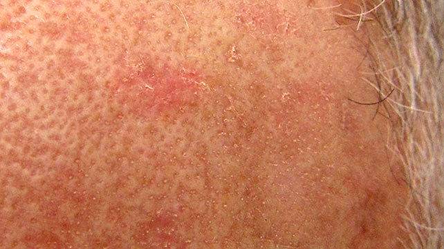 hpv dry skin patches