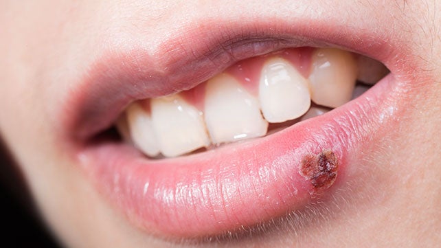 cold-sore-stages-identification-and-treatment