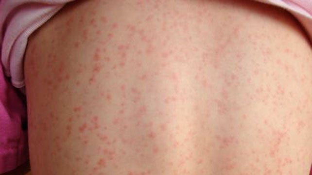 Scarlet Fever: Symptoms, Causes, Complications, and Treatment