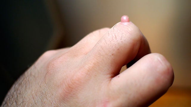 warts on hands that keep coming back