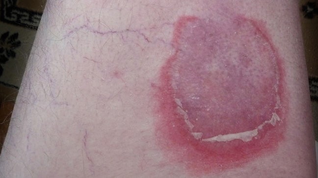 Pemphigoid: Types, Causes, and Symptoms
