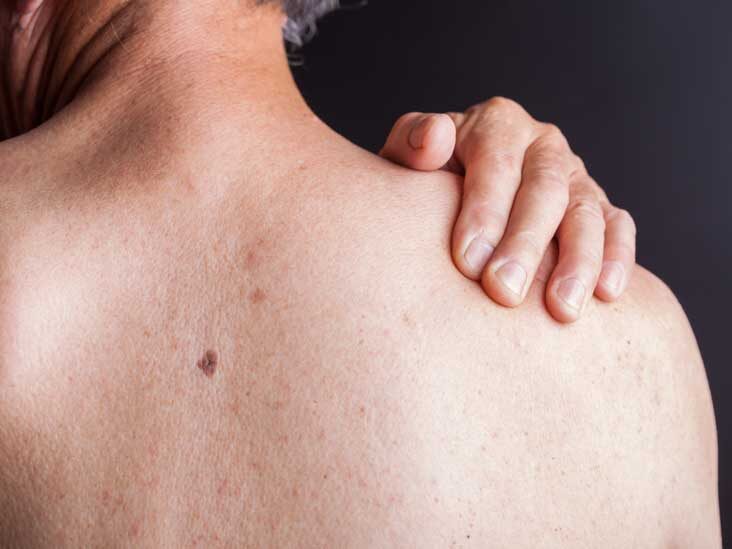 hiv rash chest