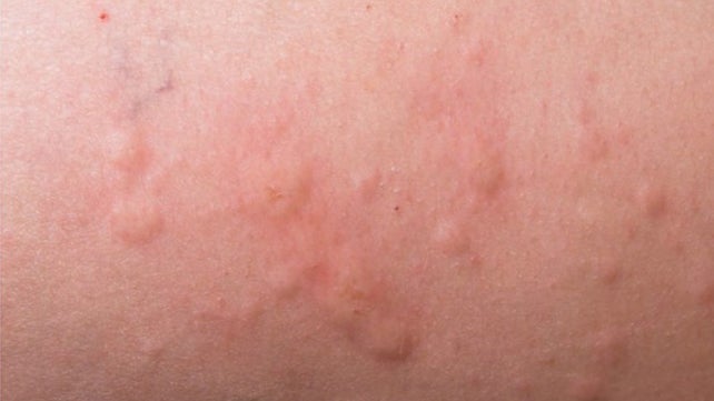 Can you get an allergic reaction to antibiotics