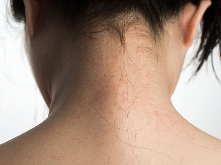psoriasis behind ears and neck)