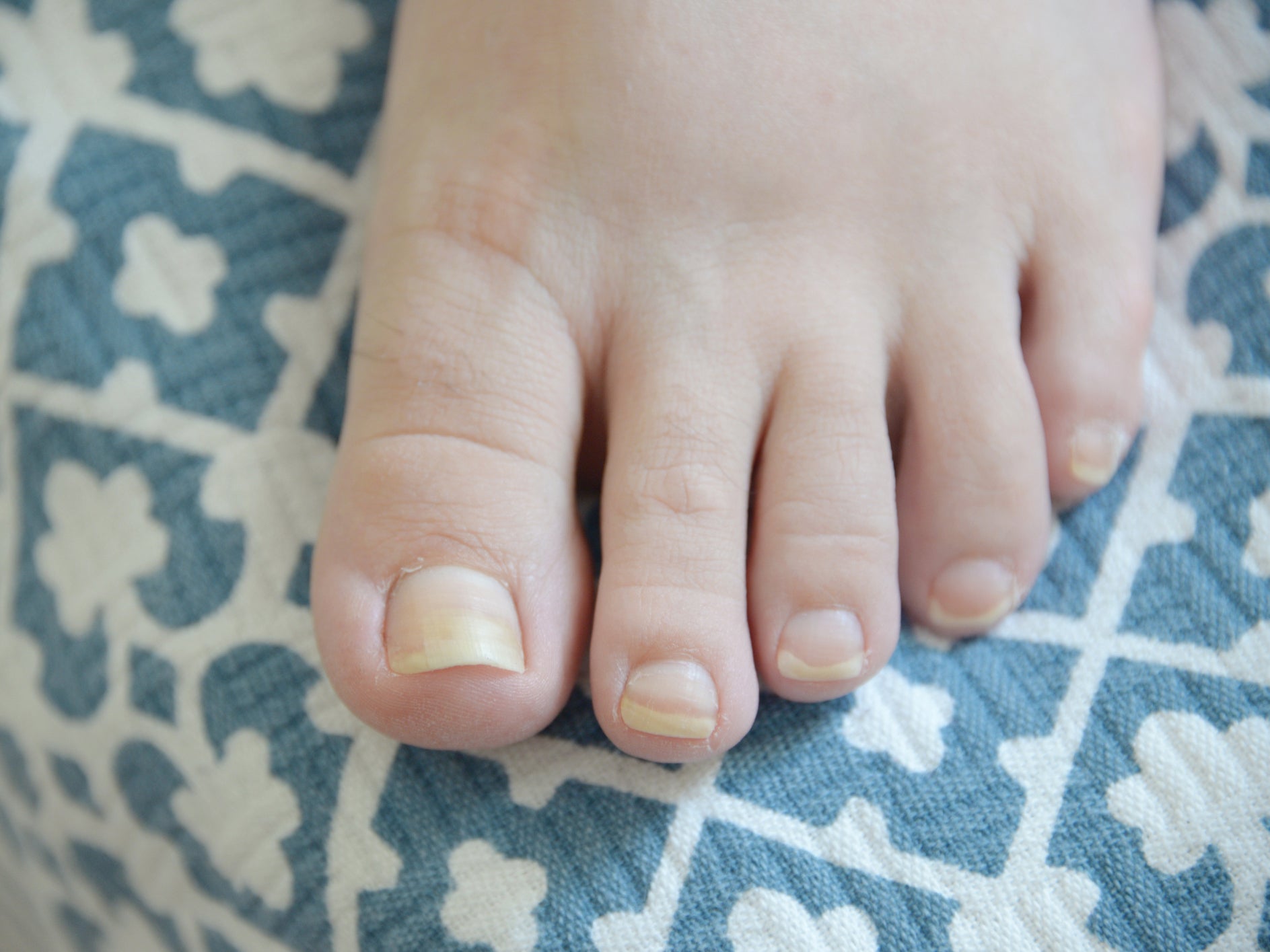A 40 year old lady with rare fungal bone infection as cause of chronic  toenail deformity