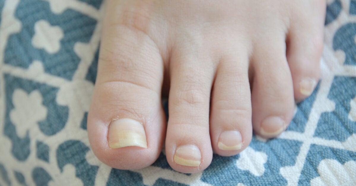 foot nail color change