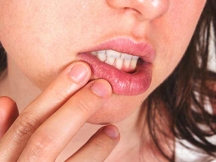 Cold Sore Stages Identification And Treatment