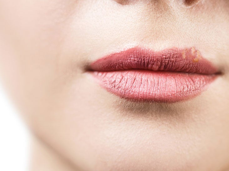 On lips bumps little clusters of