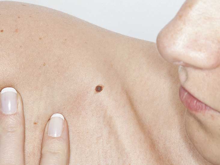 Itchy Mole Causes, Treatment, Symptoms and More