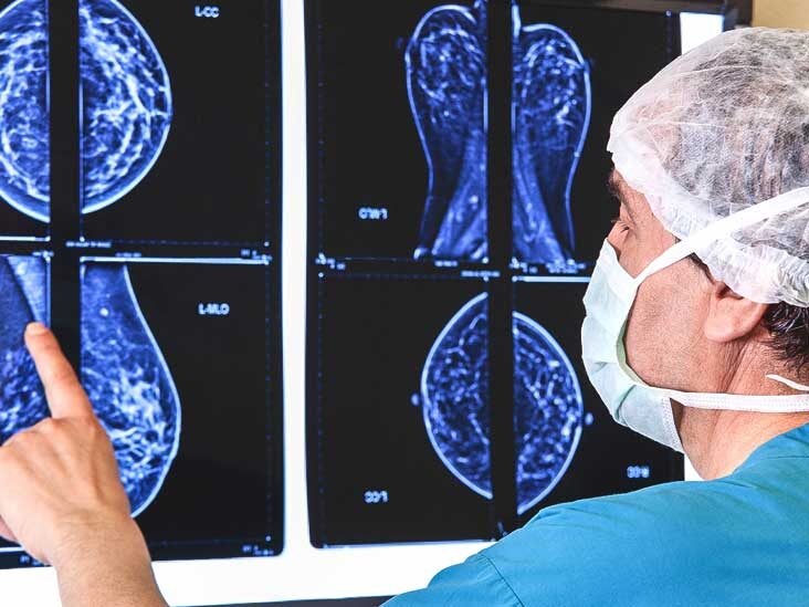 Breast MRI: Purpose, Procedure, Next Steps & More